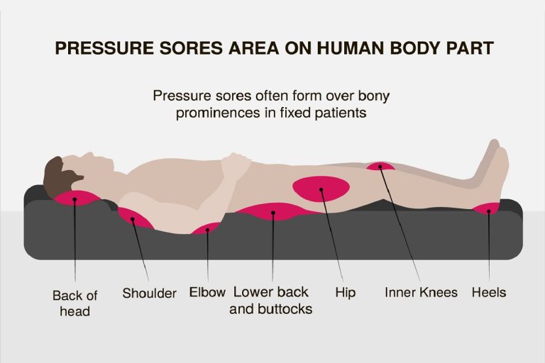 زخم بستر چیست؟